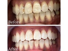 ウルル(Ululu)/ホワイトニング