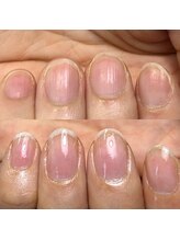ハッチネイル(HACCI nail)/お客様　before after5か月