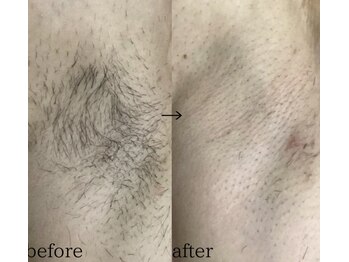 スパイリーア(Spiraea)/脱毛BeforeAfter