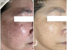 トータルビューティサロン ルボン(RUBON)/シミ、しわたるみ改善