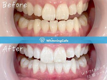 ホワイトニングカフェ 仙台店(WhiteningCafe)/☆歯のホワイトニング施術写真☆