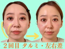ナチュラルパーフェクトフェイス 新宿/２回目・右ほうれい線/新宿小顔