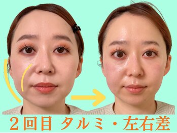 ナチュラルパーフェクトフェイス 新宿/２回目・右ほうれい線/新宿小顔