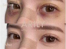 アリリィ(ARILY)/ダウンタイムケア/表参道/外苑前