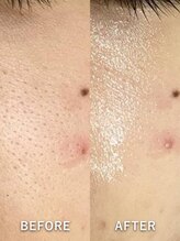ベルミーランド MEGAドン・キホーテ草加/毛穴ケアBeforeAfter