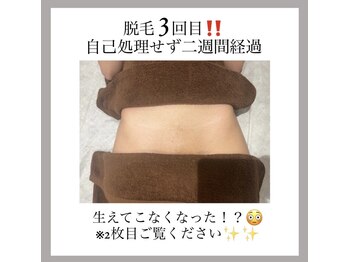 オークツリー(oak tree)/大人気VIO脱毛