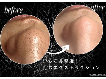 アメリオレ 国分寺店(AMELIORER)/大人気！毛穴エクストラクション