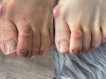 爪のいろは/諦める前に…フットケア♪