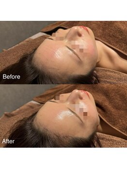 ユカリス(Yu.charis)/水光肌ミコステラ Before→After