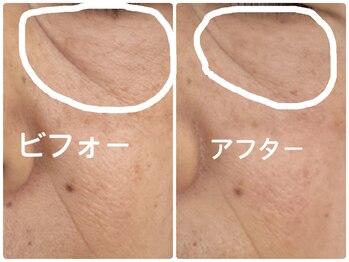 ノーブル シャット Noble Chate/気になる目の下のたるみ+しわ