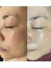 【大人女性応援】本気のシミ改善！驚きの初回体験¥22,000→8,980