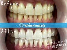 ホワイトニングカフェ 神戸元町店(WhiteningCafe)/ホワイトニングビフォーアフター