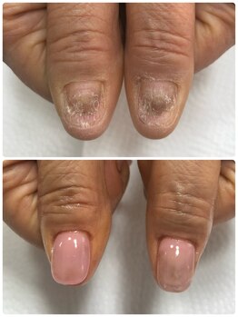 エルナ(elna)/諦めていた深爪、ご相談下さい!