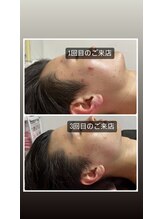 ピエノローサ(Pieno Rosa)/REVI★ハーブピーリング