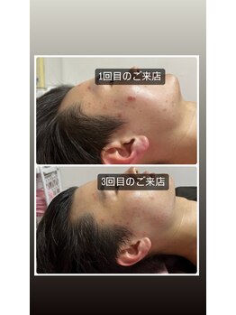 ピエノローサ(Pieno Rosa)/REVI★ハーブピーリング