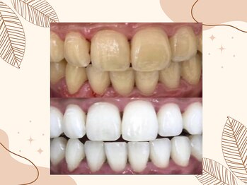 ホワイト つくば店(WHITE)/【26トーンup】16照射後のお客様