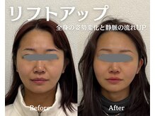 リエイド 福岡院(Re Aid.)/小顔リフトアップ