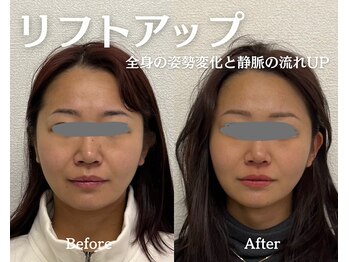 リエイド 福岡院(Re Aid.)/小顔リフトアップ