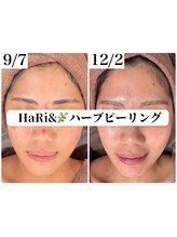 ハリト エステ(HaRi&)/毛穴洗浄/熊本/ハーブピーリング