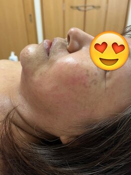 プラーベートサロン エクラ(eclat)/ハーブピーリングアフター