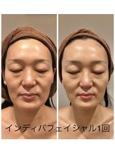 グラン セノーテ(Gran Cenote)/インディバフェイシャル