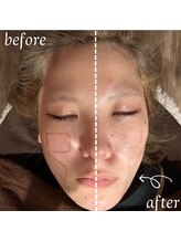 美バリ 新宿店(美BARI)/エア水光ジェット