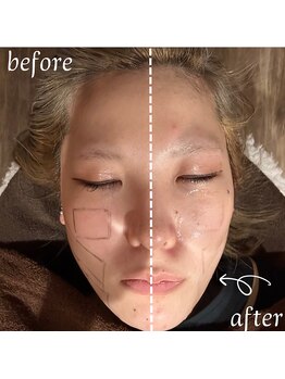 美バリ 新宿店(美BARI)/エア水光ジェット