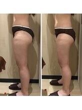 カンフリエ 吉野ヶ里店(Camphrier)/【痩身】ビフォーアフターご紹介