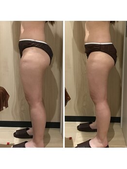 カンフリエ 吉野ヶ里店(Camphrier)/【痩身】ビフォーアフターご紹介