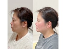 小顔22 ボルティ 赤坂支店(Bolty)/【悩み】50代：角ばった顔の輪郭