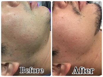 ルリアン(LeLien)/髭脱毛　施術10回の効果！！