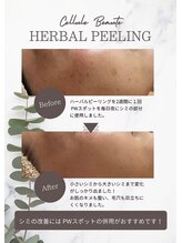 ココ(KOKO)/ハーブピーリングBeforeAfter