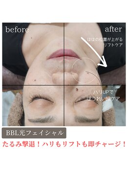 ティンクル サロン(Twinkle salon)/BBL光/すっきりフェイスライン