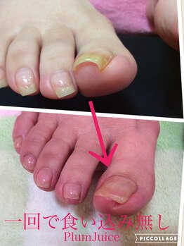 ネイルセラピーサロン プラムジュース(Nail Therapy Salon Plum Juice)/巻爪