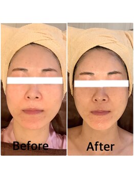 スペチアーレ 夙川/切らずにリフトアップ♪