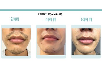 スターポルト(Star-Porte)/ヒゲ脱毛