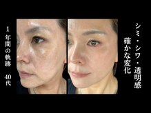 レガロビューティクリエイションズ桜川店/もう悩まない！肌荒れ改善