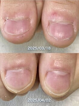 ポメロ(POMELO)/２週間で付け替え時の様子です。