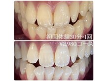 ホワイトニングルーム 横浜店(Whitening Room)/ホワイトニング/横浜