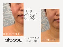 グロッシー(glossy)/【症例レモンボトル頬ライン30代