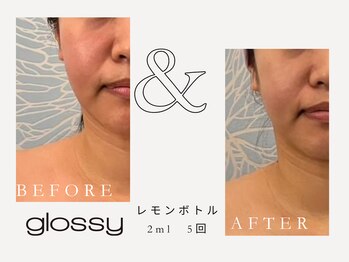 グロッシー(glossy)/【症例レモンボトル頬ライン30代