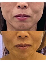 クリニカルスイート エーアール(Clinical sweet.ar)/リフトアップ+頬コケ改善Wケア