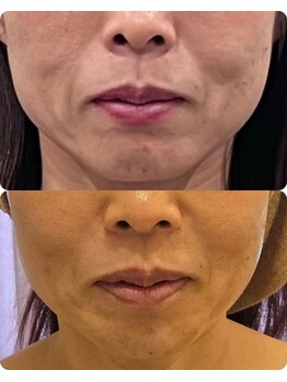 クリニカルスイート エーアール(Clinical sweet.ar)/リフトアップ+頬コケ改善Wケア