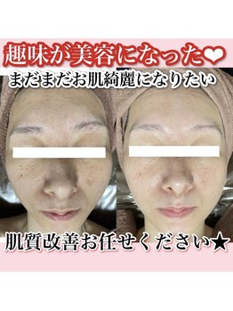 ホワイトアクア 天王寺本店(WHITE AQUA)/ララピール/毛穴洗浄/大阪