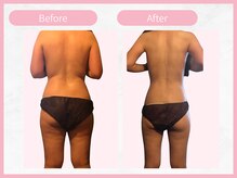 RHB 横浜店/【痩身コース】ビフォーアフター