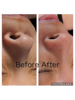 リリー(lily)/毛穴撃退