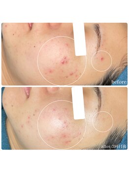 ちらちゅら/乳酸菌＋ハーブピーリング