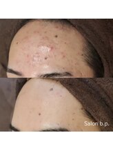 ビーピー 渋谷(b.p.)/ニキビケア　ハーブピーリング