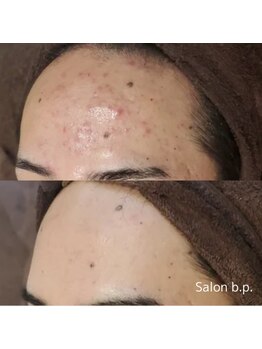 ビーピー 渋谷(b.p.)/ニキビケア ハーブピーリング