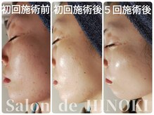 サロン ド ヒノキ(Salon de HINOKI)/水光肌☆ハーブピーリング